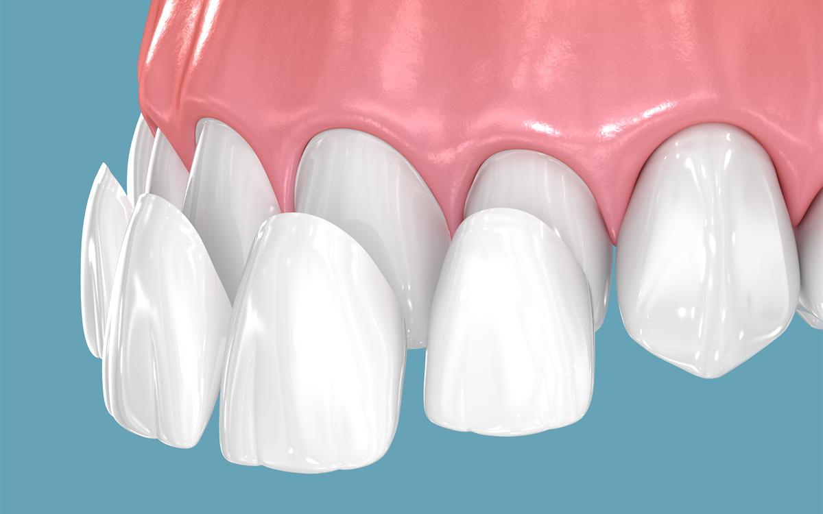 Ilustración en 3D de carillas de porcelana colocándose sobre los dientes delanteros.